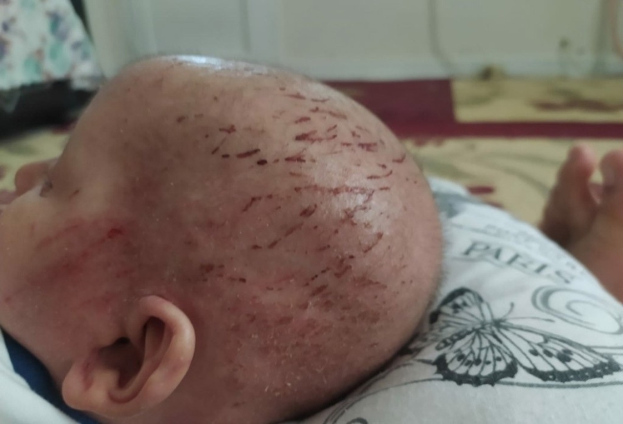 'Balık pulu' hastalığıyla yaşayan çocuğun hayatı kabusa döndü