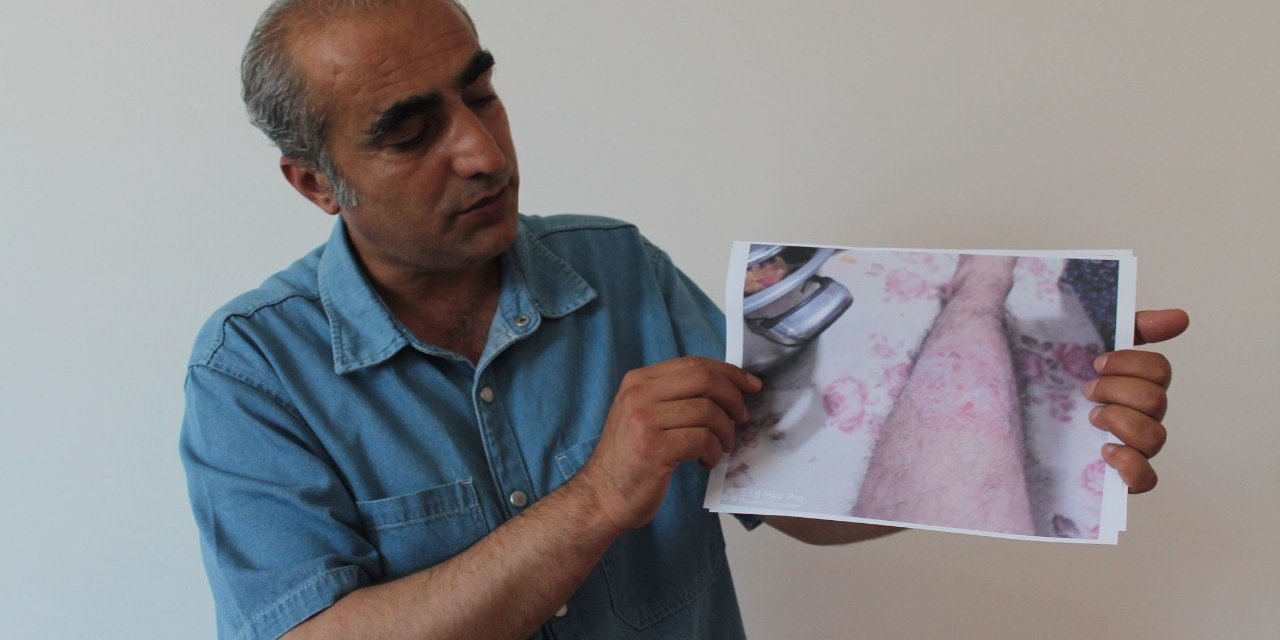 Jeoloji Mühendisi'nden 'sedef' hastalığına çözüm iddiası