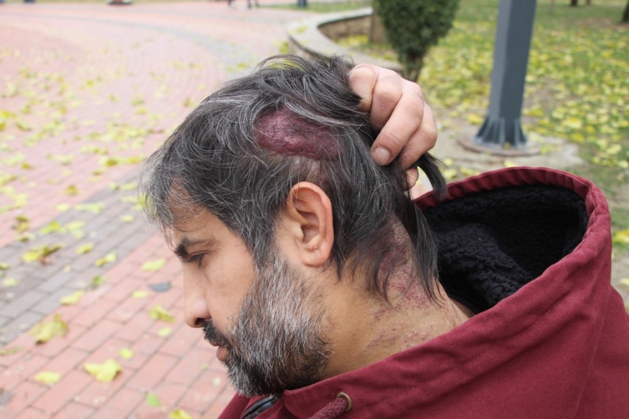 BAŞINDA OLUŞAN KİSTTEN MUZDARİP OLAN HASTAYA 12 YILDIR TEŞHİS KONULAMADI