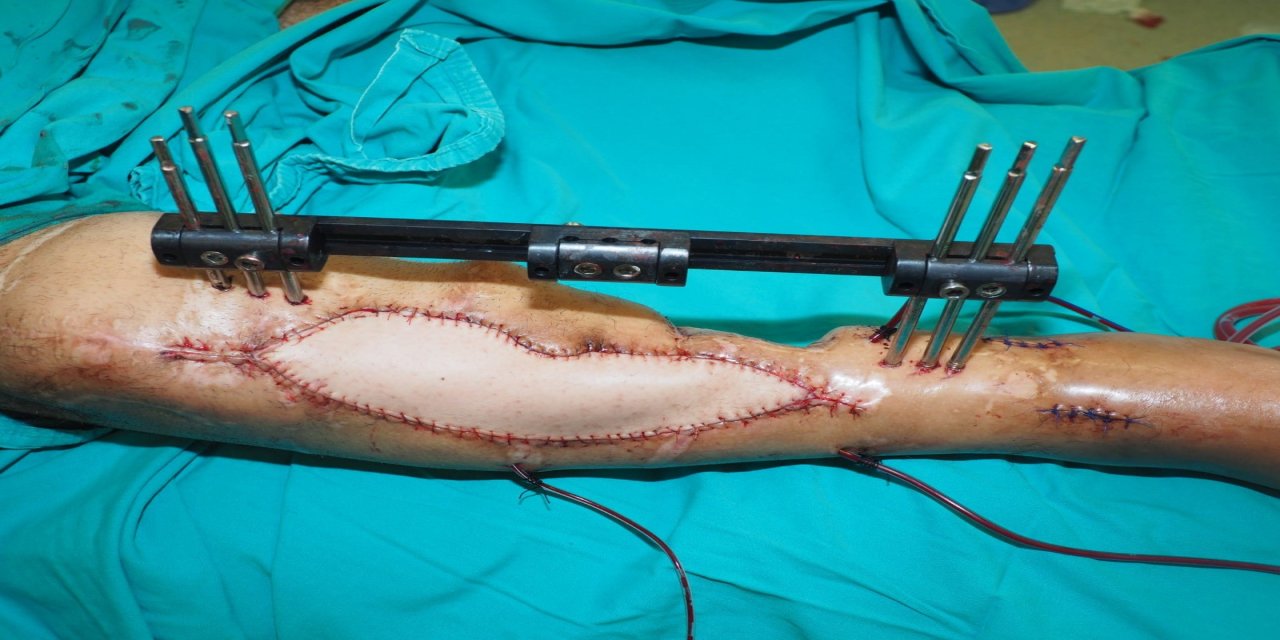 Bacağını Kaybetme Riski Vardı: 12 Başarısız Ameliyat Sonrası Yeniden Yürüyecek