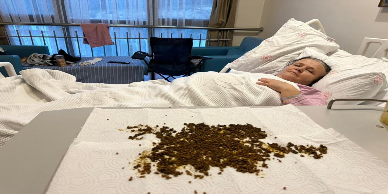 Safra Kesesinden 20 Bin Taş Çıktı! Doktorlar Sayamadı, Yapay Zeka Saydı