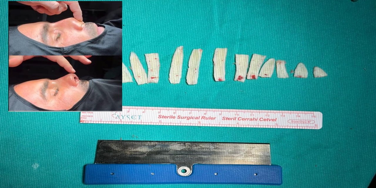 Silopi’de Travmatik Burun Deformitesine Cerrahi Müdahale