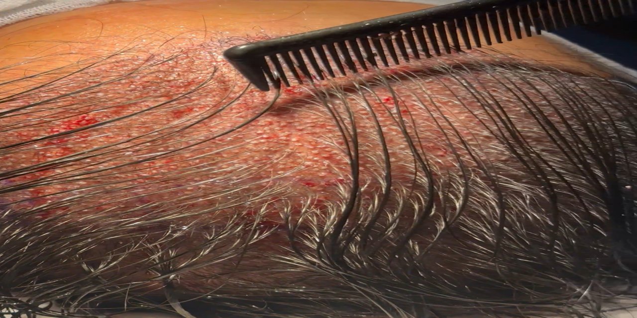 Kadınlarda tıraşsız saç ekimi mümkün mü! Uzmanı açıkladı!