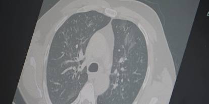 3’lü salgın Türkiye'de görüldü, Profesörden uyarı gecikmedi