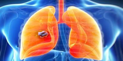 "Akciğer nodülü kanser işareti olabilir"