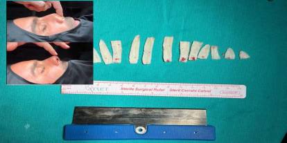 Silopi’de Travmatik Burun Deformitesine Cerrahi Müdahale