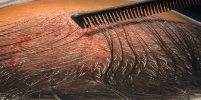 Kadınlarda tıraşsız saç ekimi mümkün mü! Uzmanı açıkladı!