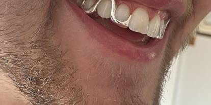 Erkeklerde diş estetiğinde yeni moda: Grillz